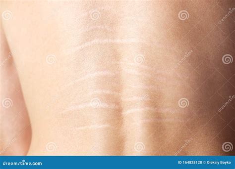 Stretch Marks In Pregnancy Royalty-Free Stock Photography | CartoonDealer.com #39620813