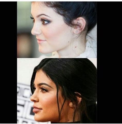 Kylie Jenner plastic surgery profile view Chin/jaw surgery Nose job ...