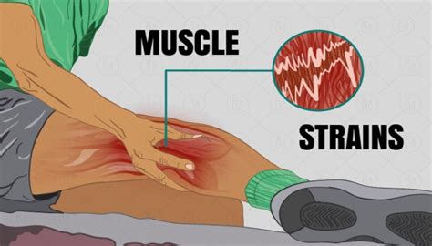 Muscle Strains: Symptoms, Causes, and Treatment • Bodybuilding Wizard