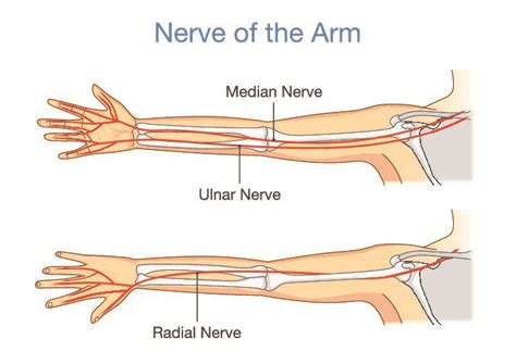 Differentiating Proximal Median Nerve Entrapment from CTS