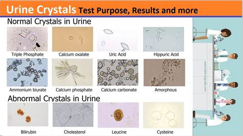Urine Crystals Test Purpose, Procedure, Results and more - Lab Tests Guide