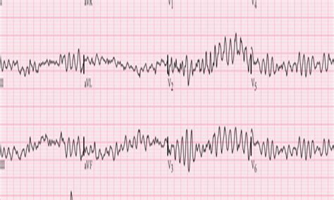 Safe to Restore Heart Rhythm - Double Sequential Defibrillation (DSD ...