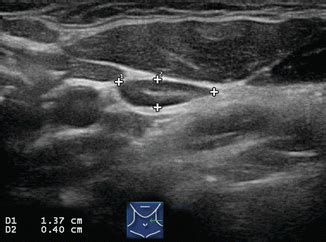 Ultrasound and Mapping of Neck Lymph Nodes | Radiology Key