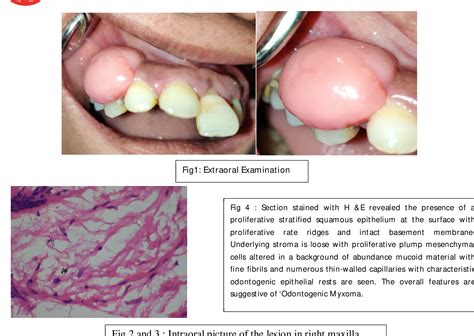 Figure 4 from Conservative Surgical Approach to Odontogenic Myxoma Involving Anterior Maxilla: A ...