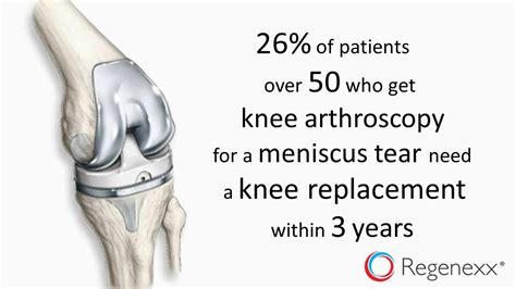 knee arthroscopy alternatives