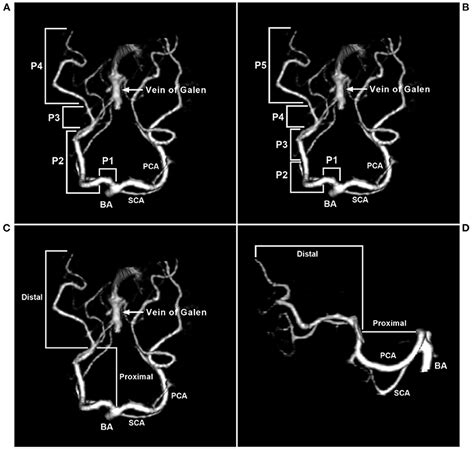 Frontiers | Endovascular Treatment of Posterior Cerebral Artery Trunk ...