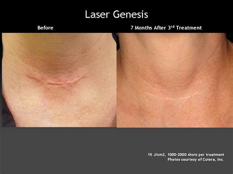 Laser Genesis - Tamra Bedford, Cosmetic RN (925) 518-5212