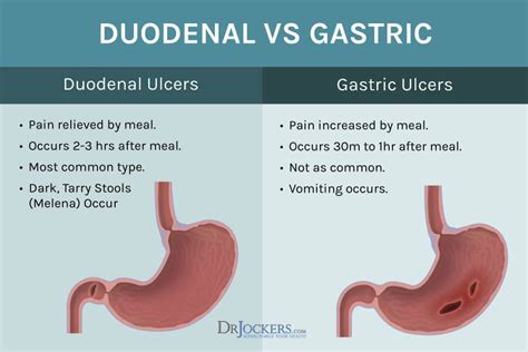 Stomach Ulcers: Causes and 16 Natural Solutions - DrJockers.com ...