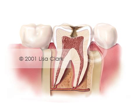 Dental Fillings 2: Progressive Tooth Decay (Cross Section) | Clark ...