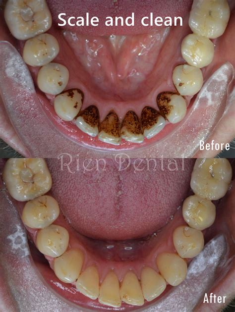 Removal of tartar, plaque and stains on teeth.