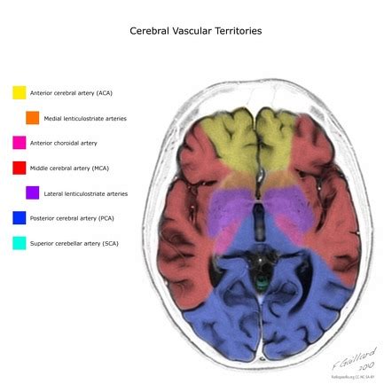 Acute basilar artery occlusion | Radiology Reference Article ...