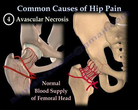 Hip flexor exercises jump higher, causes hip pain while walking uphill ...