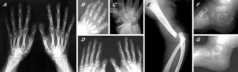 A molecular and clinical study of Larsen syndrome caused by mutations in FLNB | Journal of ...