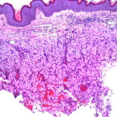 Granular Cell Tumor | Basicmedical Key