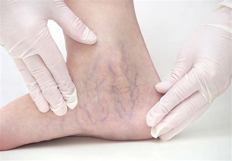 Spider Veins: Causes, Treatments, and More!