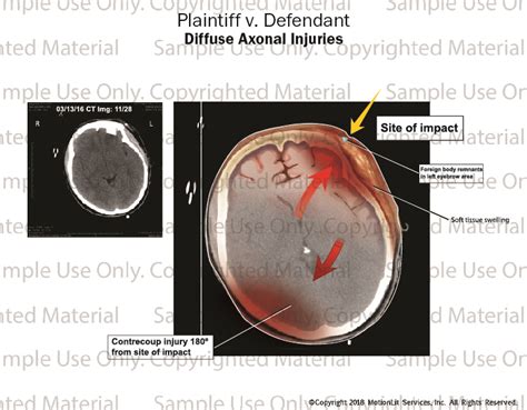 External Soft Tissue Swelling - MotionLit