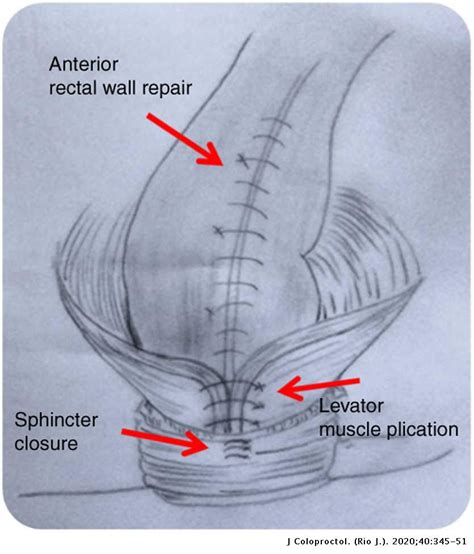 Pelvic Floor Repair Surgery | Viewfloor.co