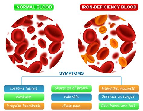 Iron Deficiency Anemia | Symptoms, Causes | Study Chemistry