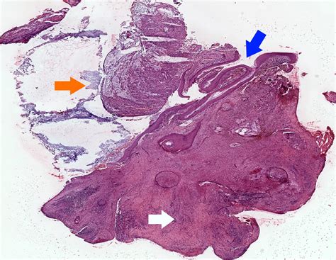 Cholesteatoma Histology