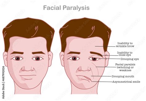 Facial paralysis. Bell palsy. Drooping eyes. twitching weakness causes ...