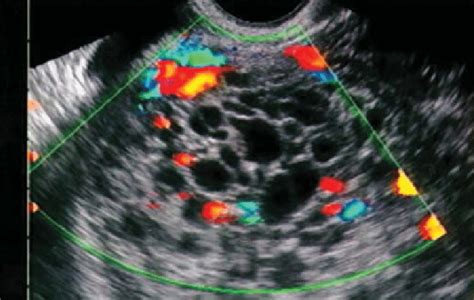 Transvaginal ultrasound in a patient with bleeding at 14 weeks of... | Download Scientific Diagram