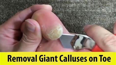 Removal Giant Calluses on Toe - YouTube