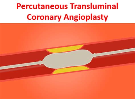 Percutaneous Transluminal Coronary Angioplasty - All About Heart And Blood Vessels