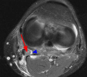 Pes Anserinus Bursitis | Radsource