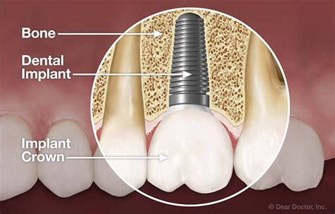 Dental Implants | Dr. P. Bekal DDS | Vandalia Ohio