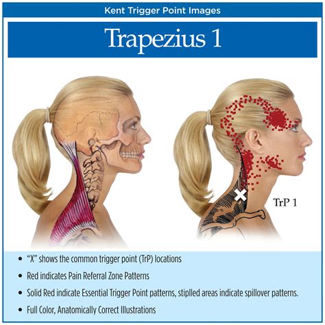 Trigger Point Charts (5 Chart Set) - Kent Health Systems