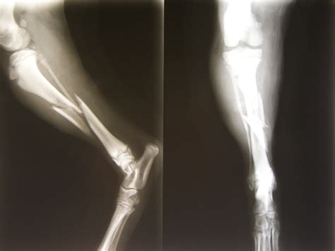 File:Fracture tibia+fibula réduite.jpg - Wikimedia Commons