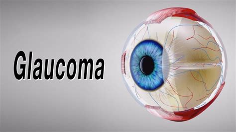 Can Glaucoma Cause Blindness?