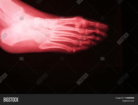 Foot Toes Injury X-ray Image & Photo (Free Trial) | Bigstock