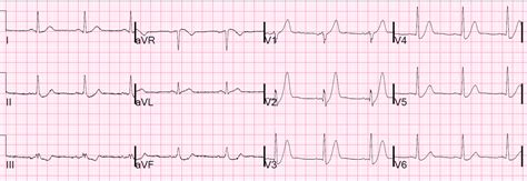 Dr. Smith's ECG Blog: De Winter's T-waves are Not a Stable ECG ...