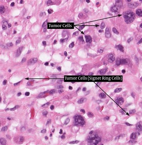 Gastric Cancer Cells