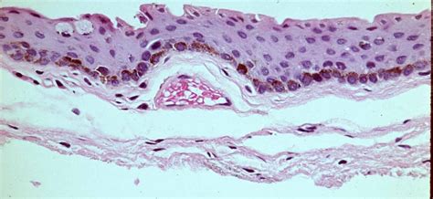 Ocular Pathology: What is benign melanosis of the conjunctiva?