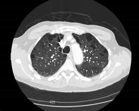 Chronic obstructive pulmonary disease chest x ray - wikidoc