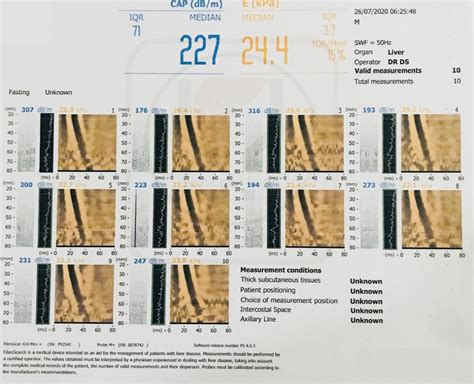 Fibroscan of liver showing advanced liver scarring | Download ...