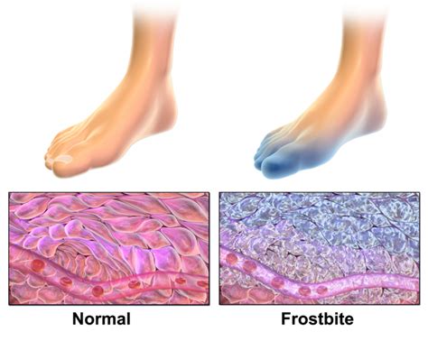 Frostbite symptoms, prevention and treatment | Caruso Foot & Ankle