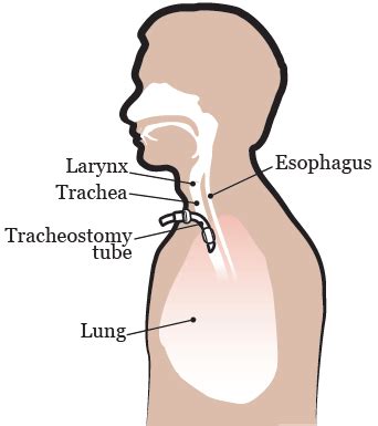 Tracheostomy Care