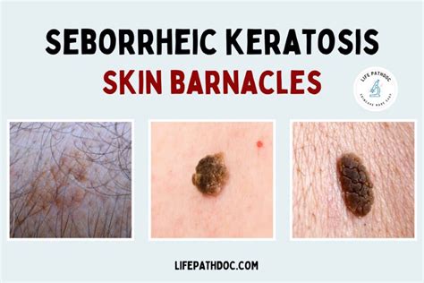 Seborrheic Keratosis (Skin Barnacles): Pictures, Cause, Removal