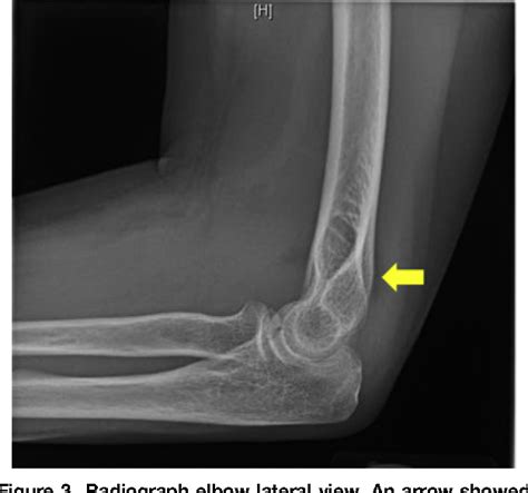 Figure 1 from Point-of-Care Ultrasound: Sonographic Posterior Fat Pad ...