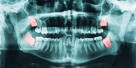 Wisdom Teeth Removal / Impacted Tooth Extraction - The procedure explained