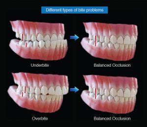 Dental Occlusion / Anterior Guidance Part 2