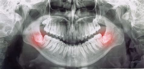 Molar Teeth Pain - Main Symptoms, Causes and Treatment