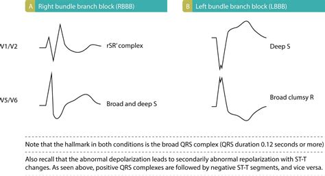 Left bundle branch block (LBBB): ECG criteria, causes, management – ECG learning