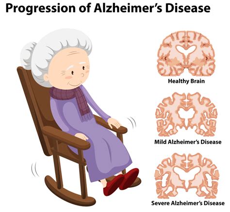 The 3 Stages of Alzheimer’s Disease: How Does the Disease Progress and Can You Stop It ...