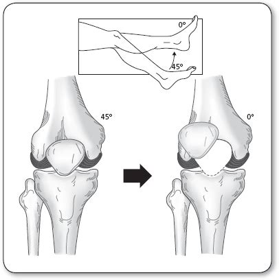 Anterior Knee Pain | Anesthesia Key