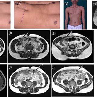 (PDF) Beevor's sign: a potential clinical marker for GNE myopathy