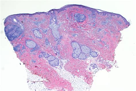 VIRTUAL GRAND ROUNDS IN DERMATOLOGY 2.0: Granulomatous Rosacea